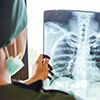 Chest XRay